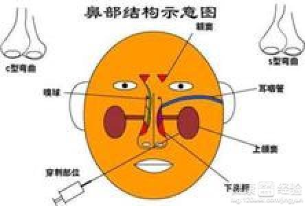 鼻竇炎有哪些癥狀用什么藥治療,鼻竇炎的癥狀、治療與用藥全面分析說(shuō)明,系統(tǒng)解答解釋定義_版章90.87.11