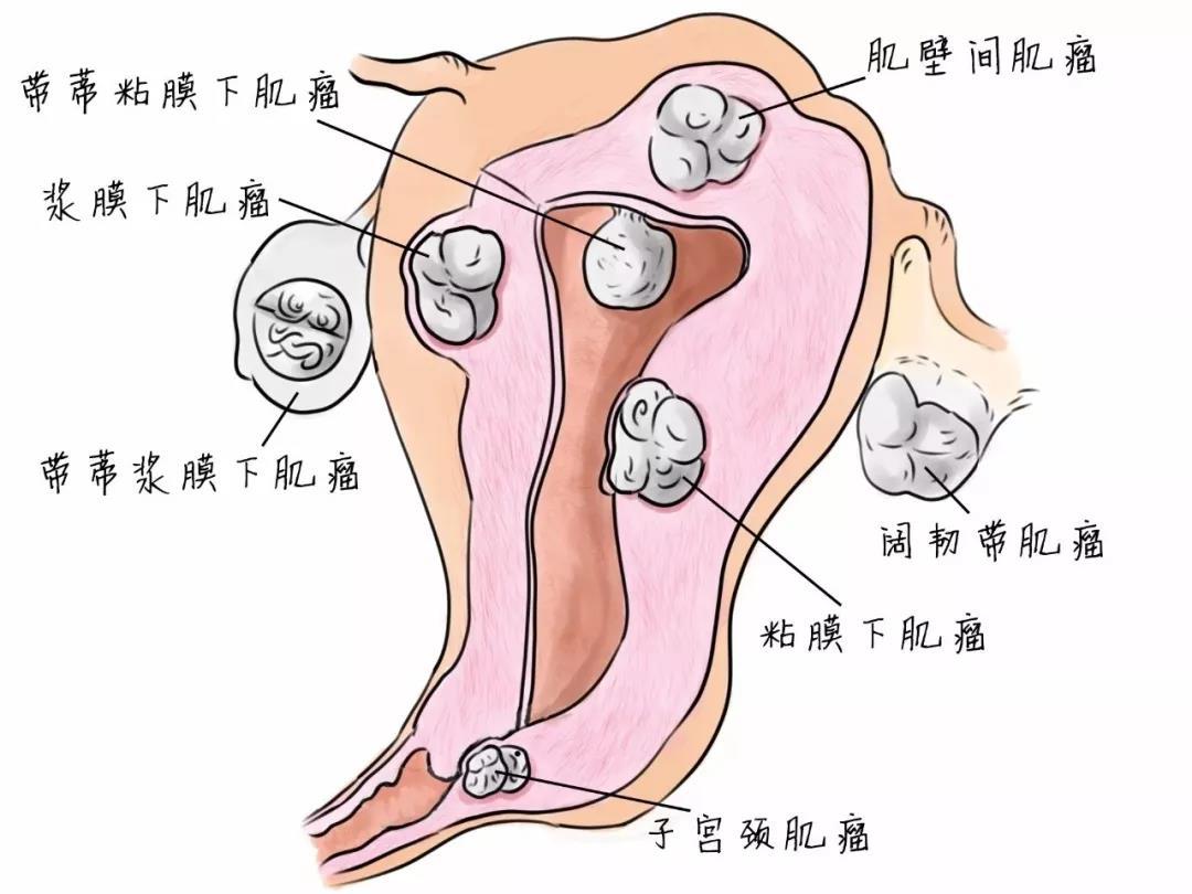 子宮肌瘤咨詢免費(fèi)專家,子宮肌瘤咨詢免費(fèi)專家，深度解析與數(shù)據(jù)執(zhí)行研究,創(chuàng)新策略解析_云端版21.84.98