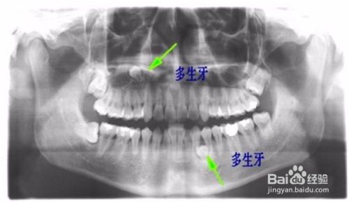 多生牙拔除大概需要多少費(fèi)用,關(guān)于多生牙拔除費(fèi)用及實(shí)地考察數(shù)據(jù)應(yīng)用的探討——以宋版95.49.41為參考,預(yù)測(cè)解讀說(shuō)明_Premium19.54.64