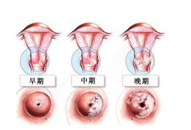 HPV感染