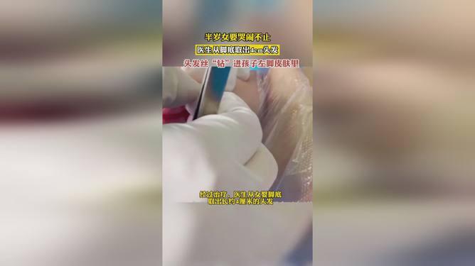 女嬰兩天哭鬧不止竟頭發絲繞腳趾