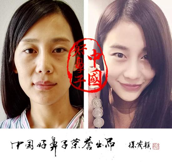 杳一下今晚澳門(mén)碼資料,21歲女孩被曝做隆鼻手術(shù)后死亡