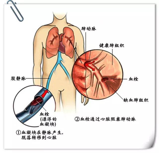 4949澳門正版資料,女子崴腳靜養(yǎng)一周后竟引起肺栓塞